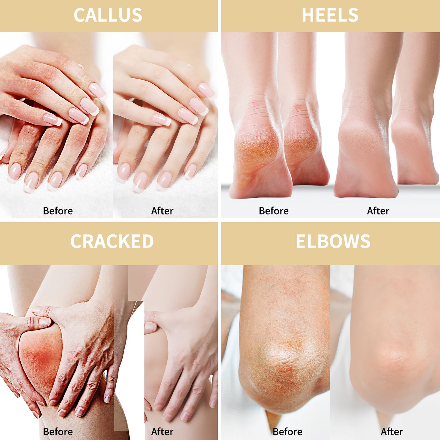 50% Urea Cream for Feet Maximum Strength (with oats and 2% salicylic acid), foot and hand cream with hyaluronic acid, tea tree and aloe vera for deep moisturizing and callus removal