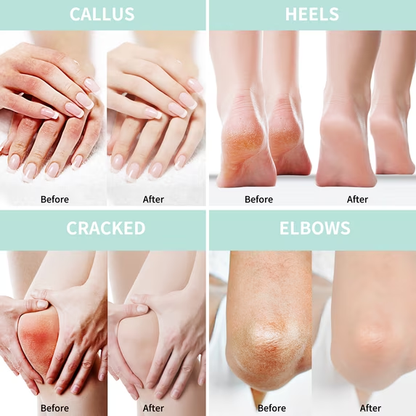 2 Packs Urea Cream 40 Plus Salicylic Acid 5.30 oz || Foot Cream and Hand Cream, with Hyaluronic Acid, Tea Tree, and Aloe Vera, Callus Remover and Cracked Heel Repair Care