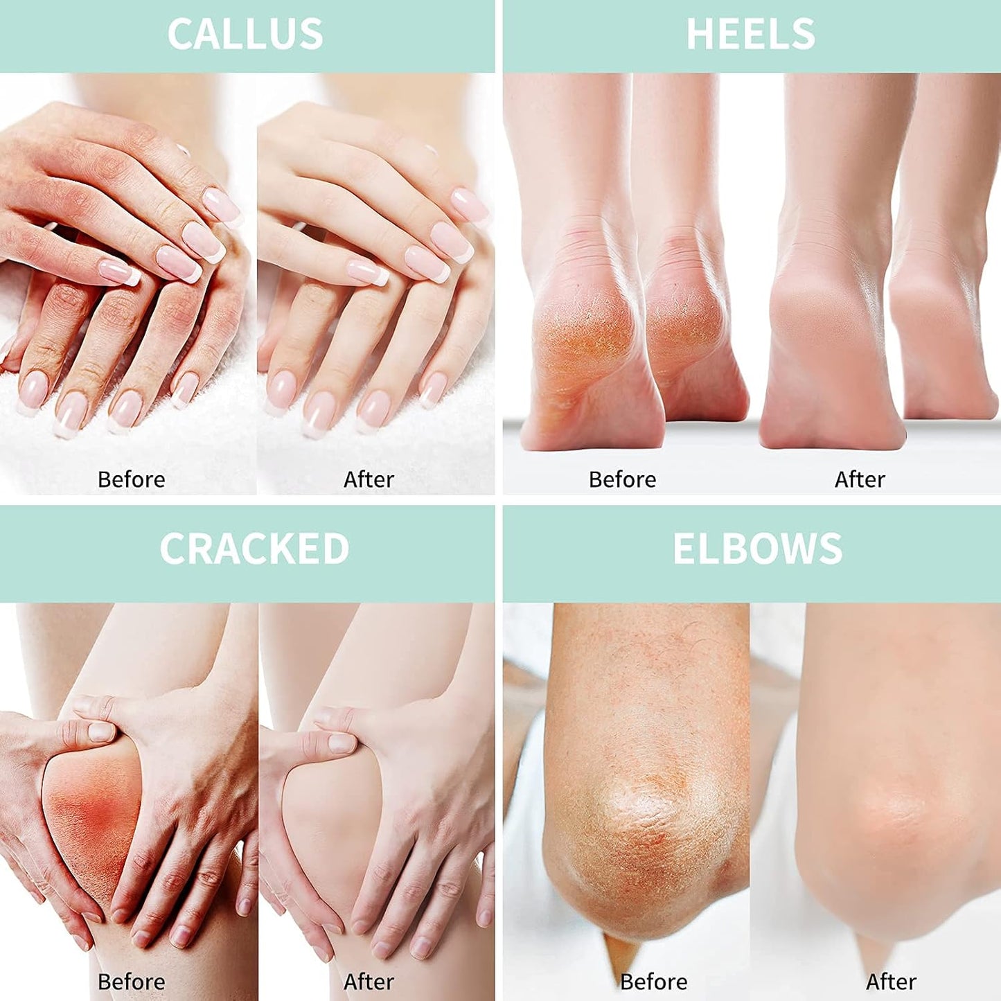 Grocerism Urea 40% Cream for Feet with 2% Salicylic Acid, Thick & Dry, Callus Remover, Hand Cream with Hyaluronic Acid, Tea Tree & Aloe Vera, 5.29 oz